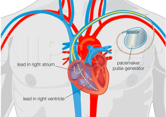 Pacemaker،